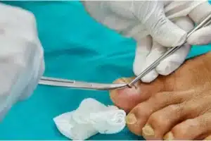 Tırnak Çektirmek İçin Hangi Bölüme Gidilmeli? 1 tırnak çektirmek